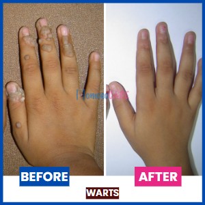 Before and after images of warts. After image shows warts removed through homeopathic treatment for warts